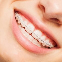 Ceramic braces use tooth-colored brackets that…