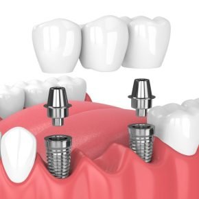 Dental Implants_ Traditional VS_ Mini Dental Implants