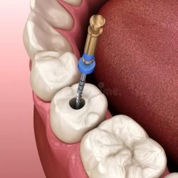 Endodontic Root Canal Treatment Process_ Medically Accurate Tooth Illustration Stock Illustration - Illustration of membrane, care_ 180481447