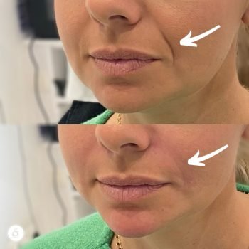 Filler Nasolabial Folds Before & After