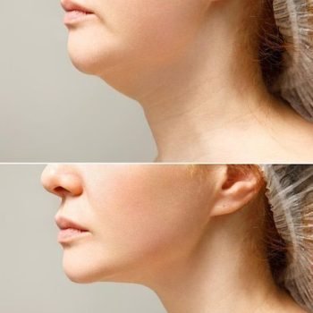 How to remove double chin fast _ loose face fat exercises double chin _ remove face fat