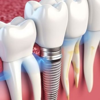 Smile Confidently Again_ The Journey with an Implant Dentist in Corpus Christi