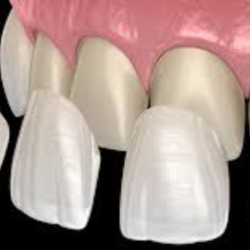 Teeth-Veneering