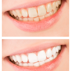 Teeth-wr