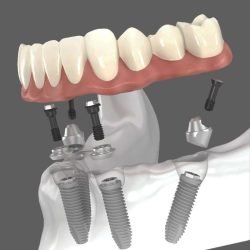 With the All-on-4 dental implant restoration…